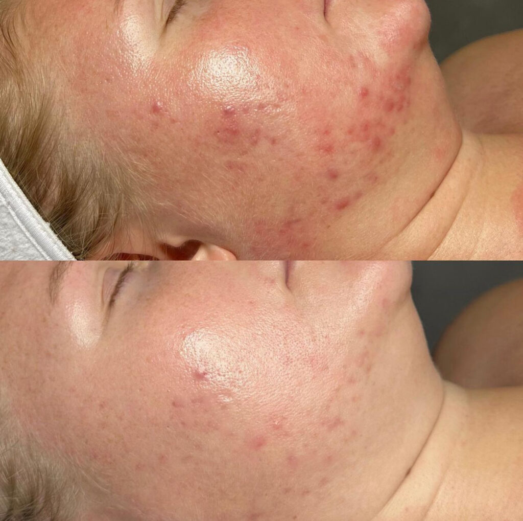 Trattamento Anti Acne, Hello Beauty Roma