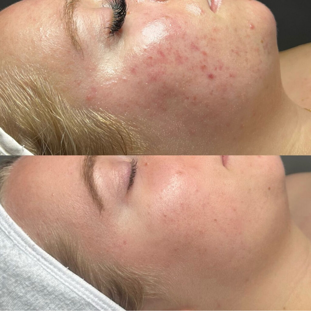 Trattamento Anti Acne, Hello Beauty Roma