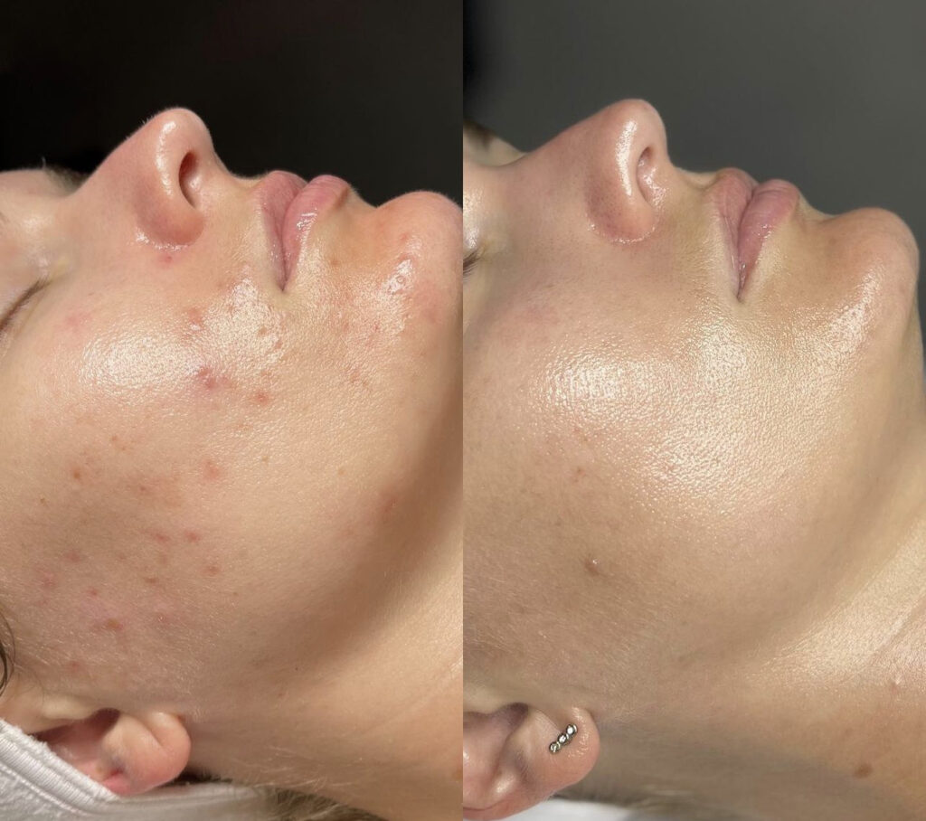 Trattamento Anti Acne, Hello Beauty Roma