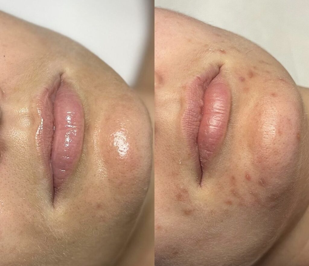 Trattamento Anti Acne, Hello Beauty Roma