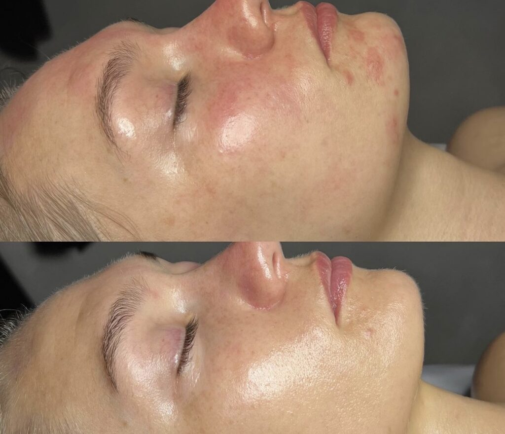 Trattamento Anti Acne, Hello Beauty Roma