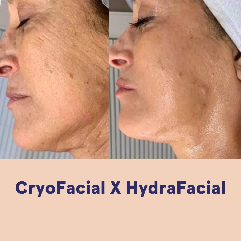 HYDRAFACIAL DIAMOND, Hello Beauty Roma