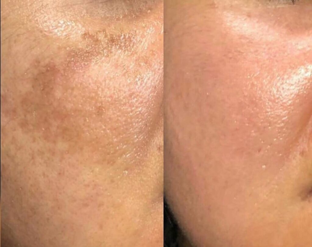 Microneedling viso post acne, Hello Beauty Roma