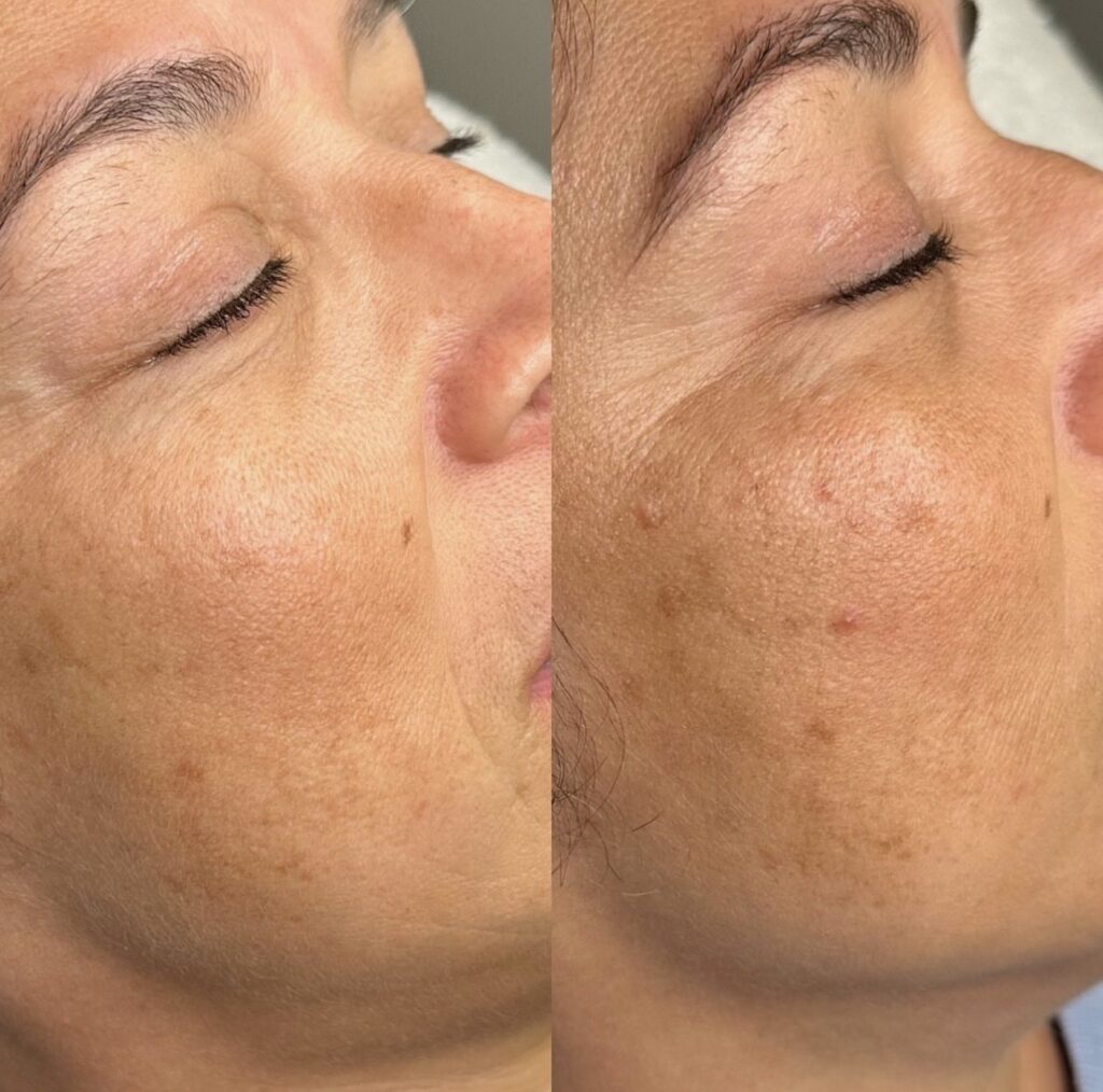 Microneedling viso post acne, Hello Beauty Roma