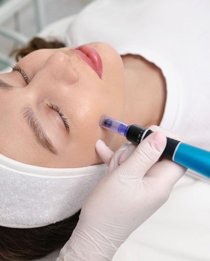 Microneedling - pacchetto da 3 sedute (viso), Hello Beauty Roma
