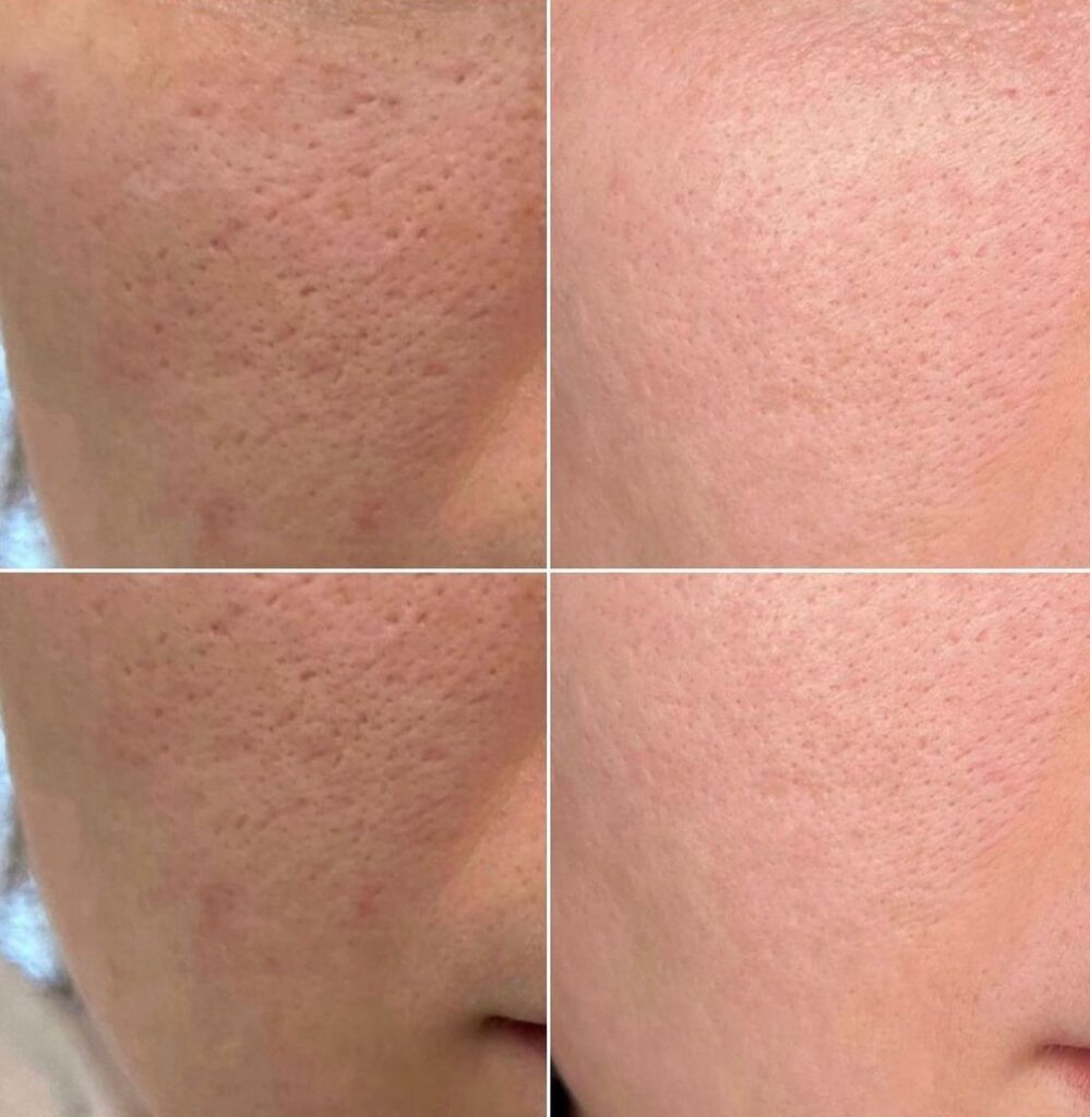Microneedling - pacchetto da 3 sedute (viso), Hello Beauty Roma