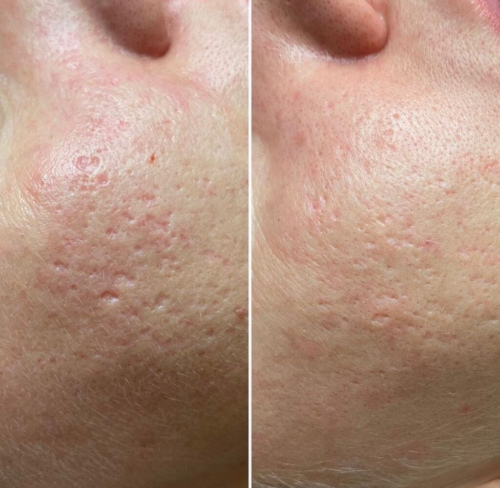 Microneedling - pacchetto da 3 sedute (viso), Hello Beauty Roma