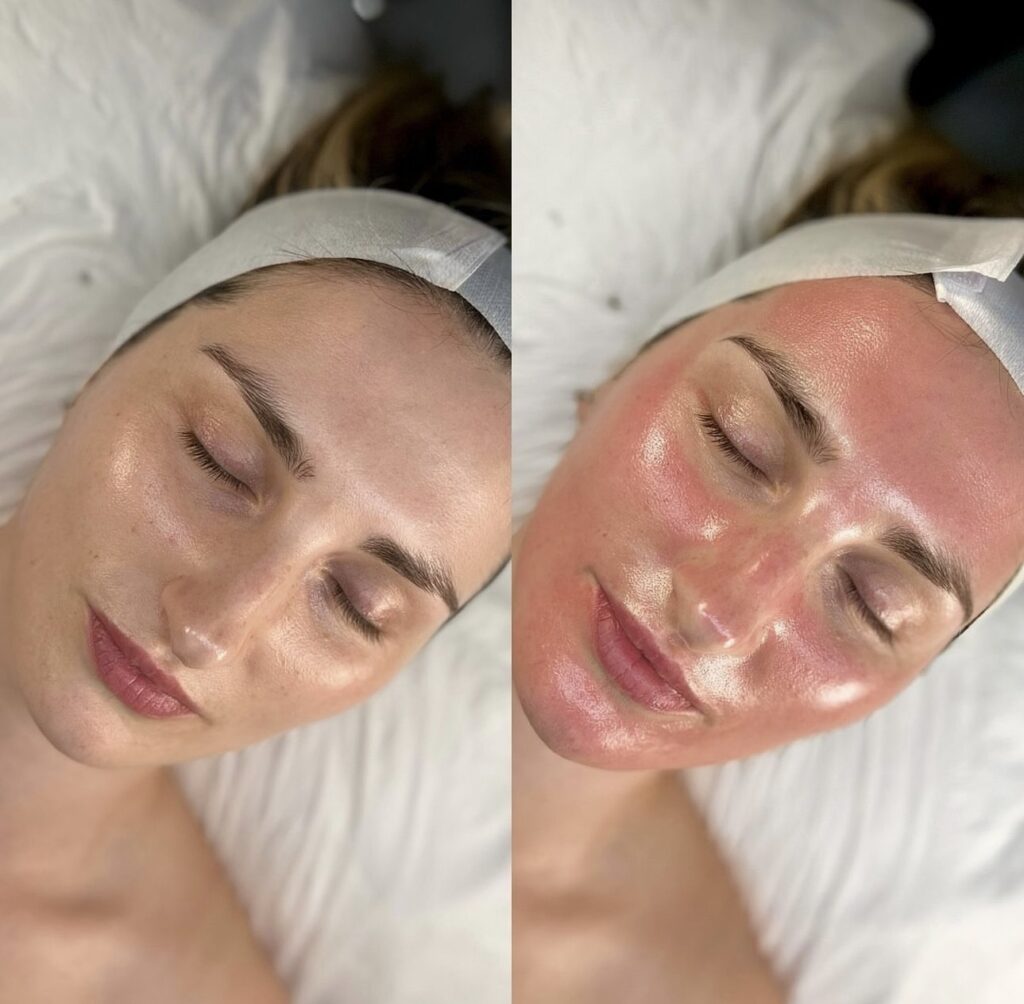 Microneedling con Exosomes, Hello Beauty Roma