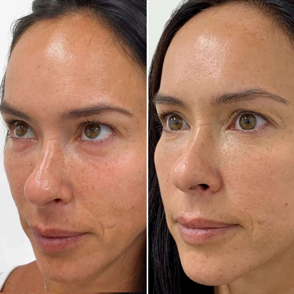 Microneedling con EXOSOMES - pacchetto da 3 sedute, Hello Beauty Roma
