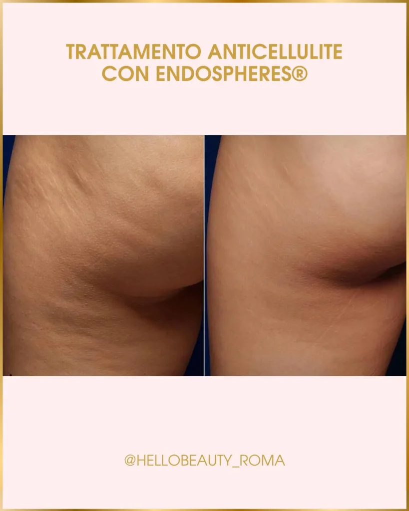 Endospheres Therapy, Hello Beauty Roma