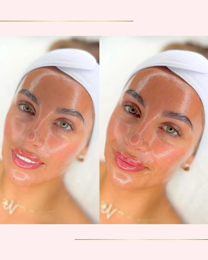 Hydrafacial Platinum, Hello Beauty Roma
