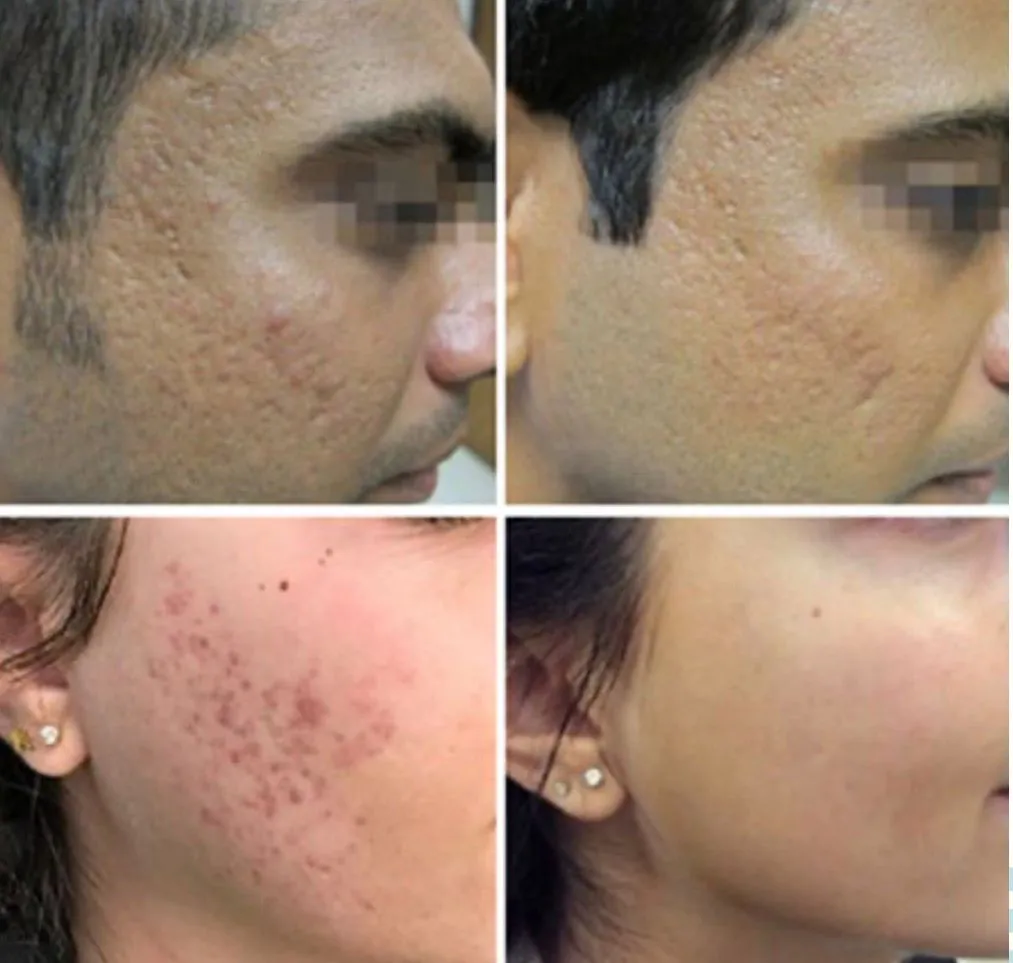 RF Lifting Fractora Roma, Hello Beauty Roma