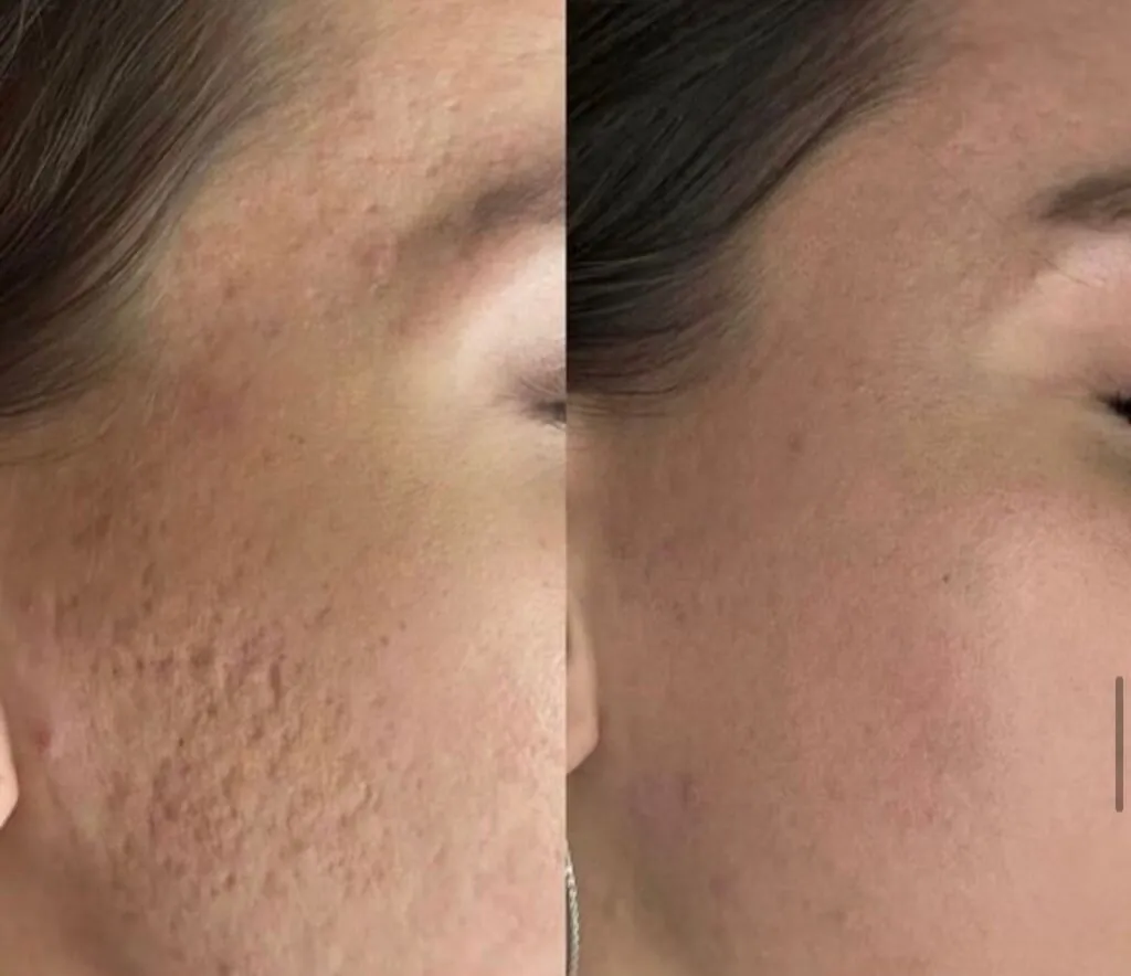 RF Lifting Fractora Roma, Hello Beauty Roma