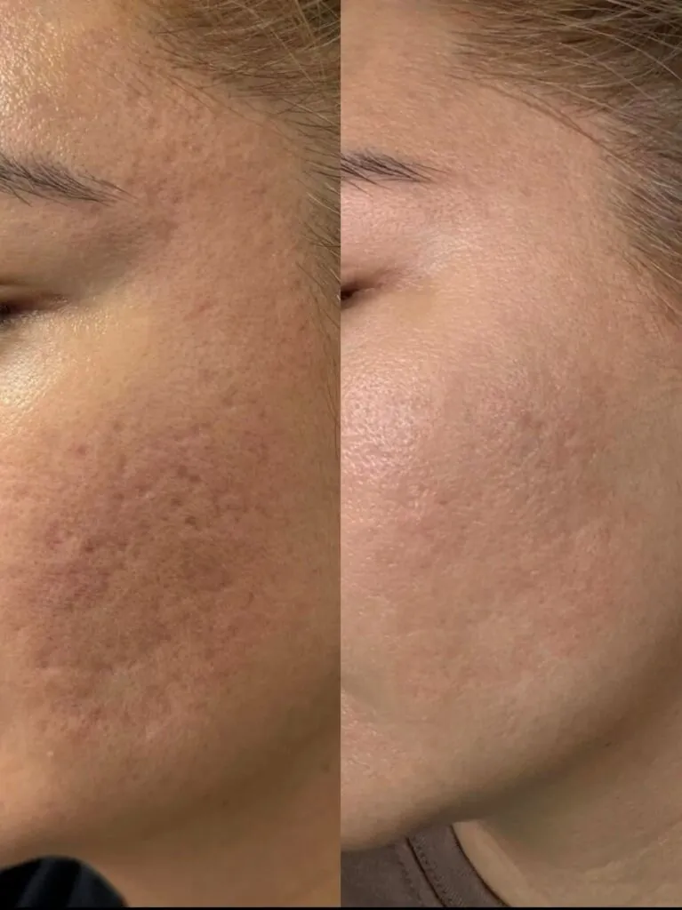 RF Lifting Fractora Roma, Hello Beauty Roma