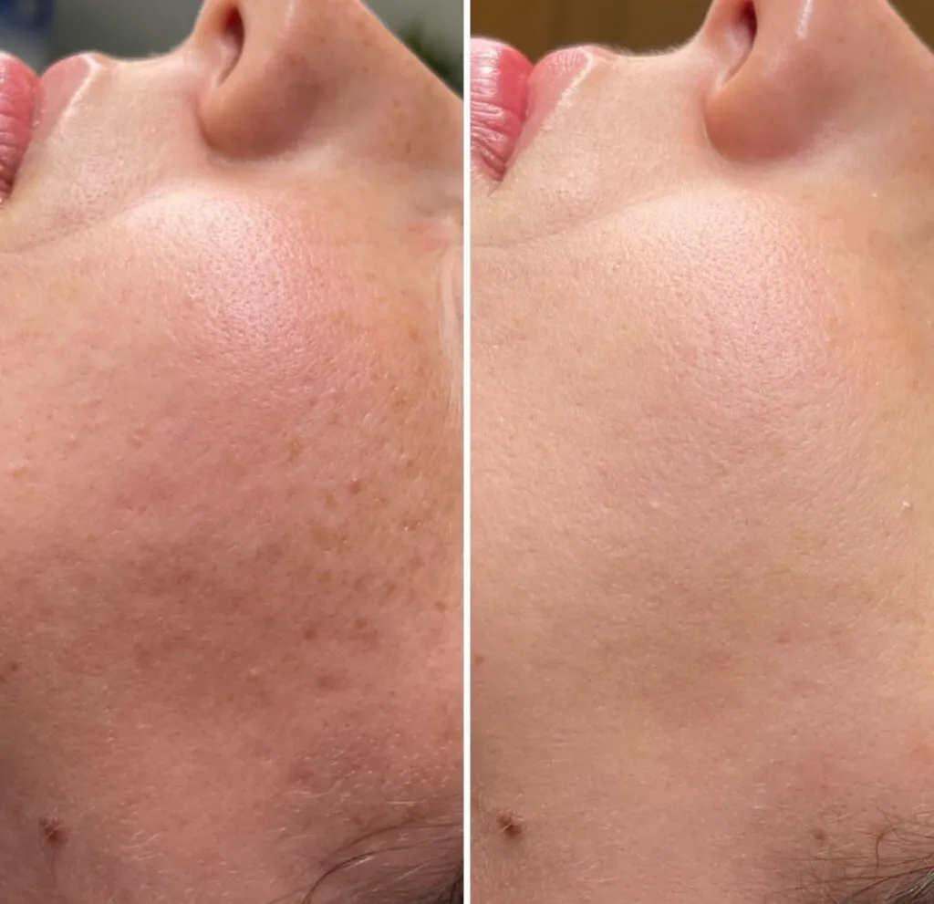 Microneedling con Exosomes, Hello Beauty Roma