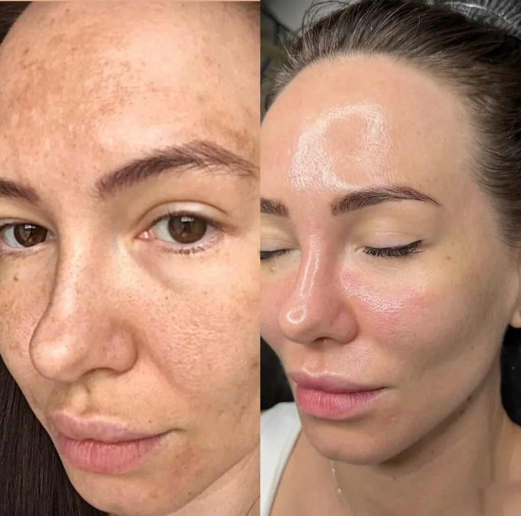 Microneedling con EXOSOMES - pacchetto da 3 sedute, Hello Beauty Roma