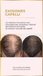 Microneedling Hair con Exosomes a Roma, Hello Beauty Roma