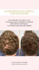 Microneedling Hair con Exosomes a Roma, Hello Beauty Roma