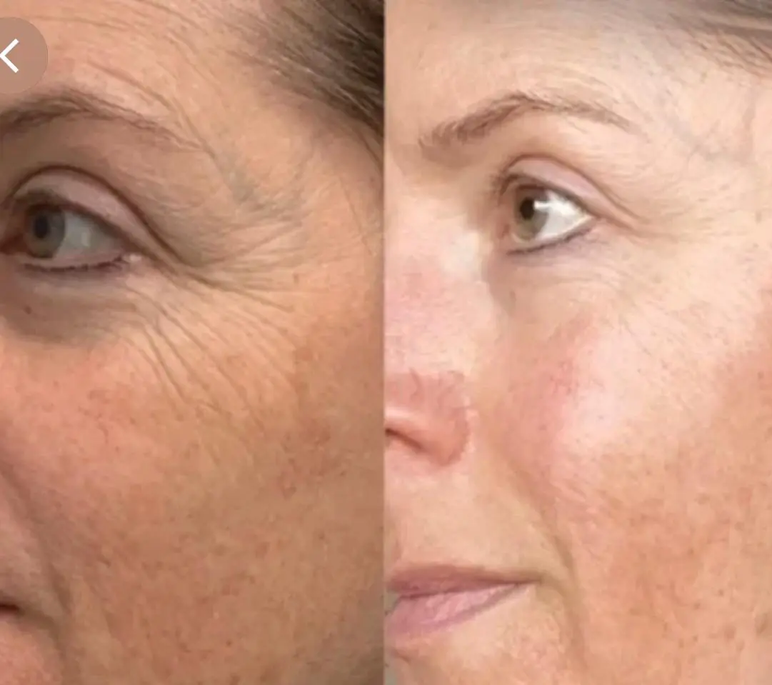 Microneedling con Esosomi + PDRN AMESON, Hello Beauty Roma