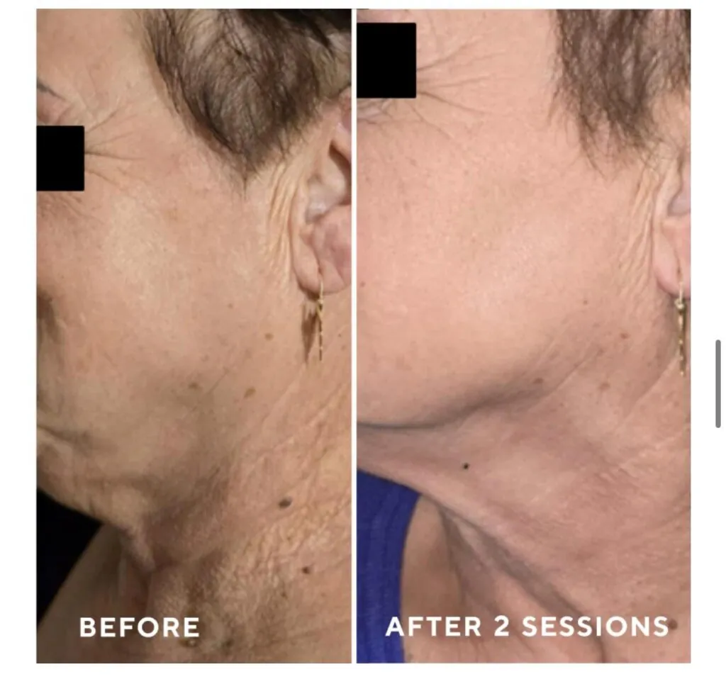 Microneedling con Esosomi + PDRN AMESON, Hello Beauty Roma