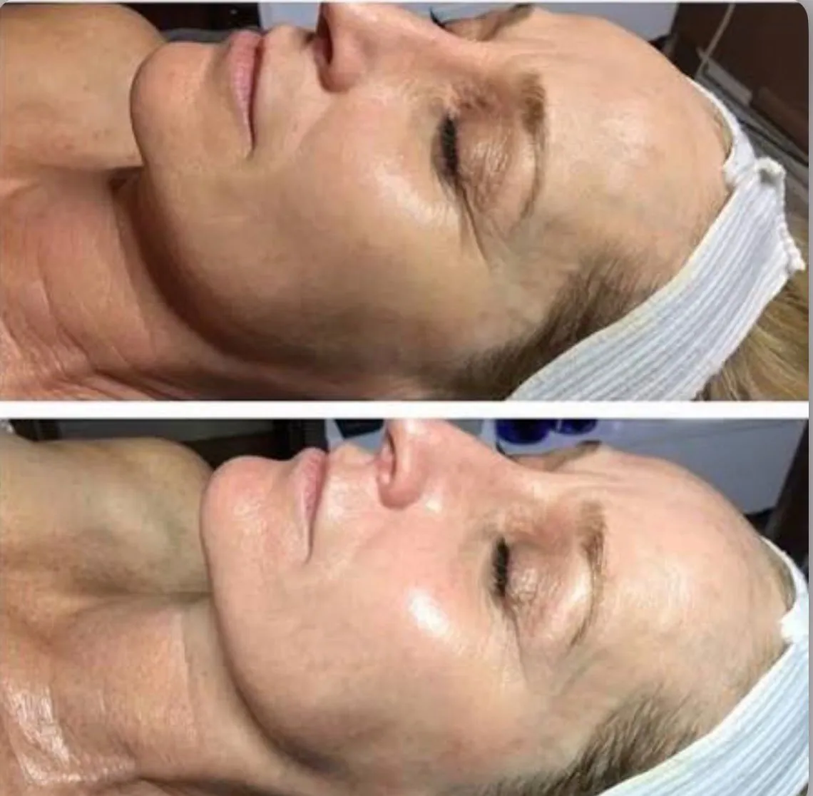 Trattamento Red Carpet/Fuoco e Ghiaccio (IS CLINICAL®), Hello Beauty Roma