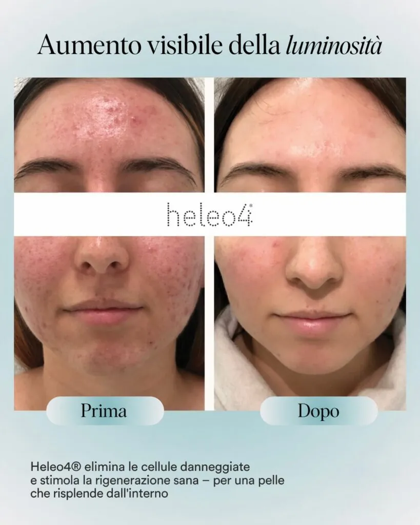 Heleo 4 Led Therapy, Hello Beauty Roma