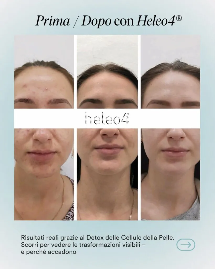 Heleo 4 Led Therapy, Hello Beauty Roma