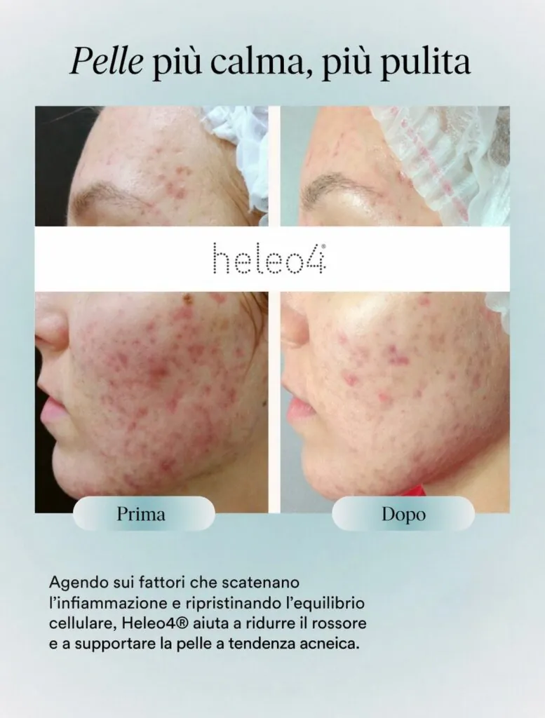 Heleo 4 Led Therapy, Hello Beauty Roma